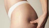 Cellulite: nuovo metodo non invasivo