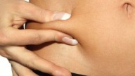 Cellulite: meno liposuzione, più laser